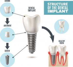 Dental Implant Technology